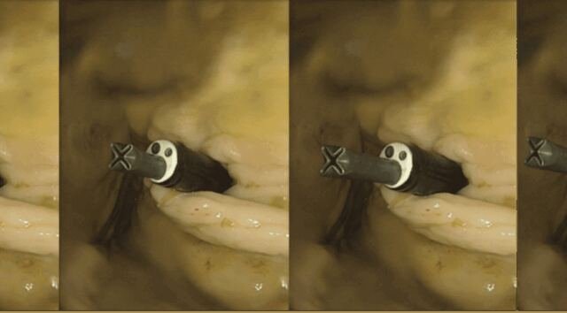 Pressure-free growing robots for soft medical robotics